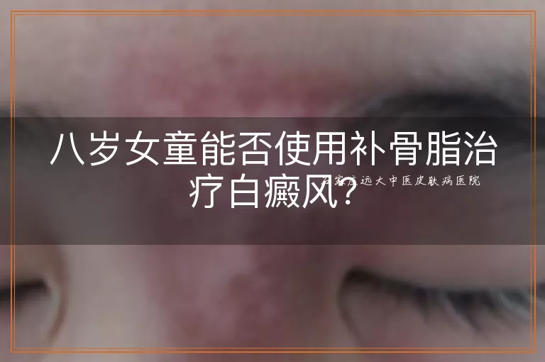 八岁女童能否使用补骨脂治疗白癜风？
