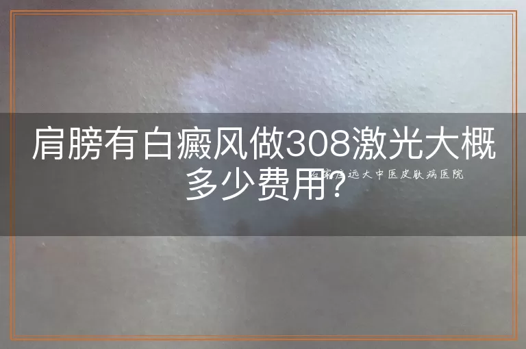 肩膀有白癜风做308激光大概多少费用？