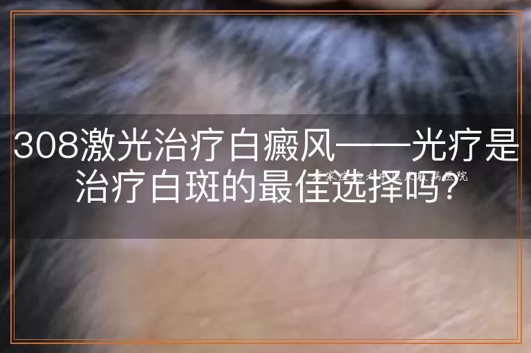 308激光治疗白癜风——光疗是治疗白斑的最佳选择吗？