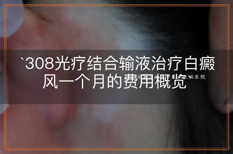 308光疗结合输液治疗白癜风一个月的费用概览