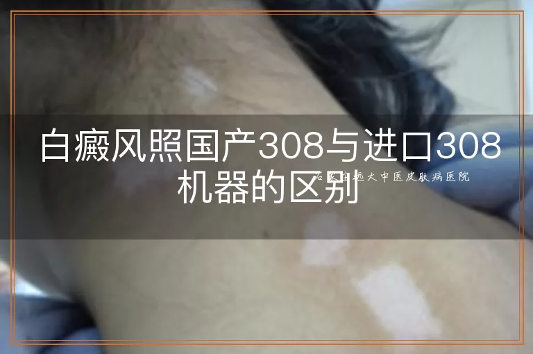 白癜风照国产308与进口308机器的区别