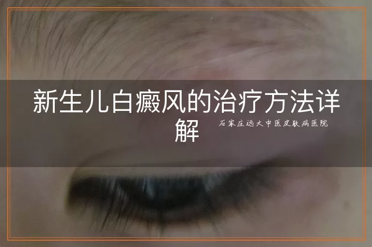 新生儿白癜风的治疗方法详解