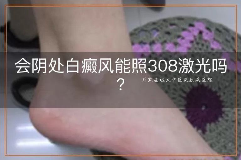 会阴处白癜风能照308激光吗？