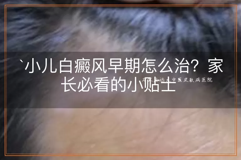 小儿白癜风早期怎么治?家长必看的小贴士