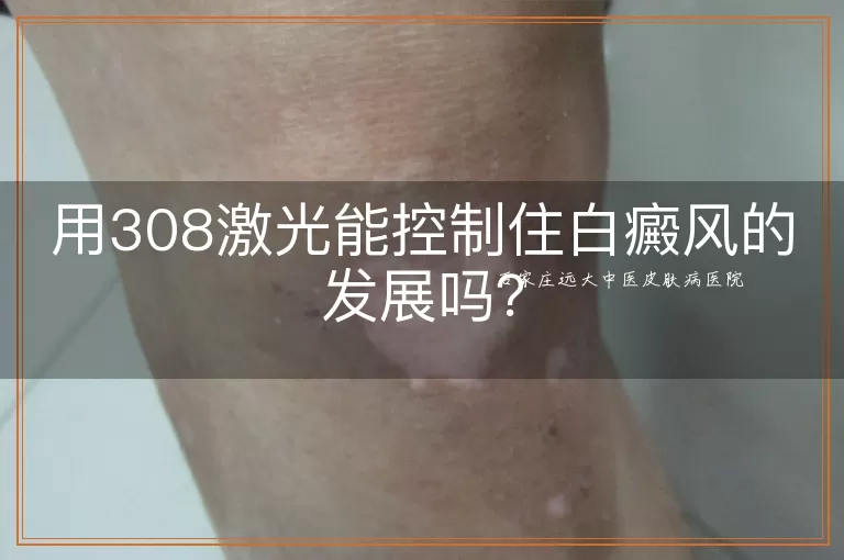 用308激光能控制住白癜风的发展吗？