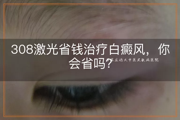 308激光省钱治疗白癜风，你会省吗？