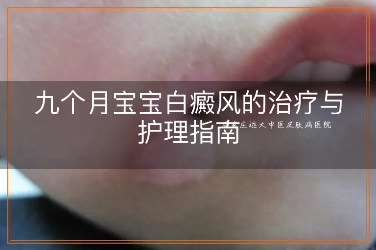 九个月宝宝白癜风的治疗与护理指南