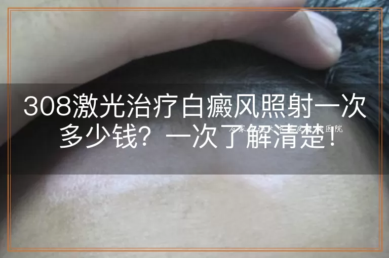 308激光治疗白癜风照射一次多少钱？一次了解清楚！
