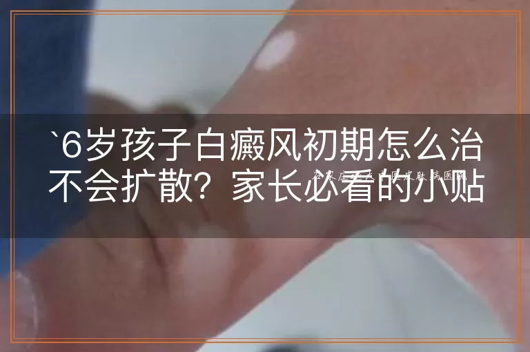 6岁孩子白癜风初期怎么治不会扩散?家长必看的小贴士!