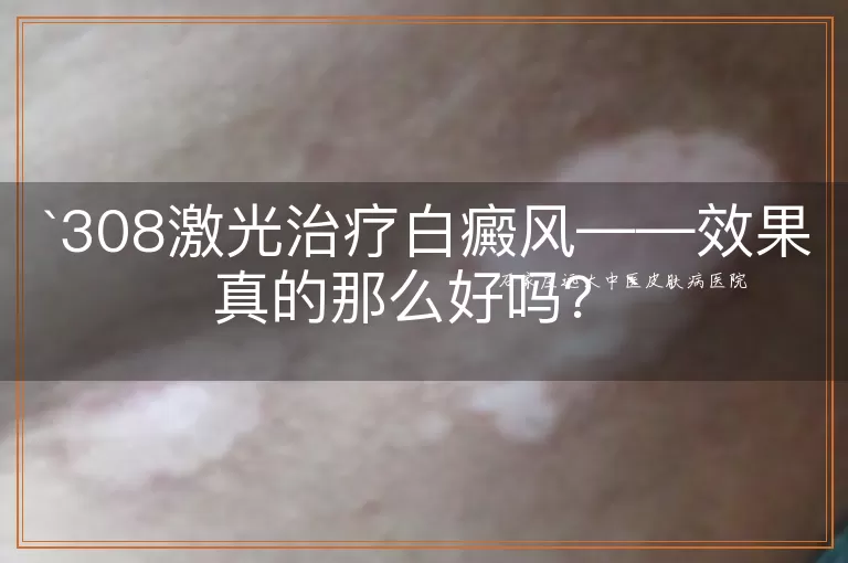 308激光治疗白癜风——效果真的那么好吗？