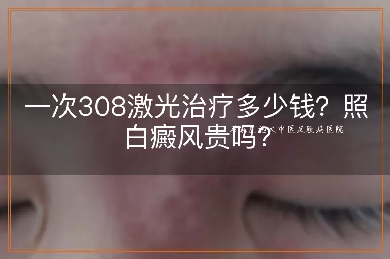 一次308激光治疗多少钱？照白癜风贵吗？
