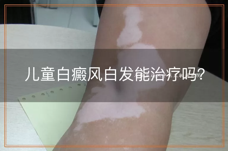 儿童白癜风白发能治疗吗？