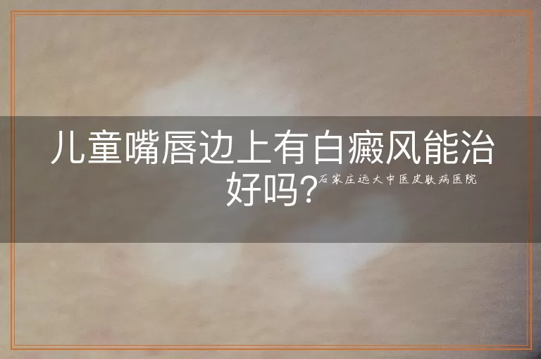 儿童嘴唇边上有白癜风能治好吗？