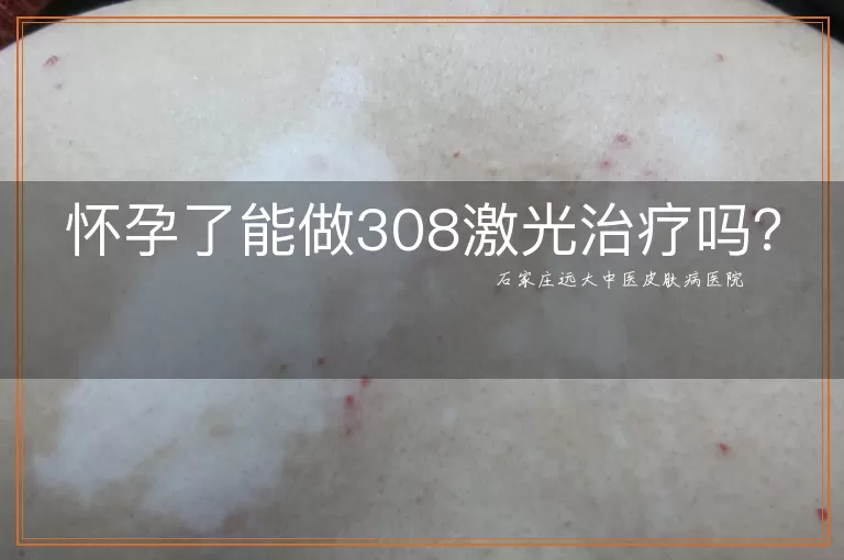 怀孕了能做308激光治疗吗?