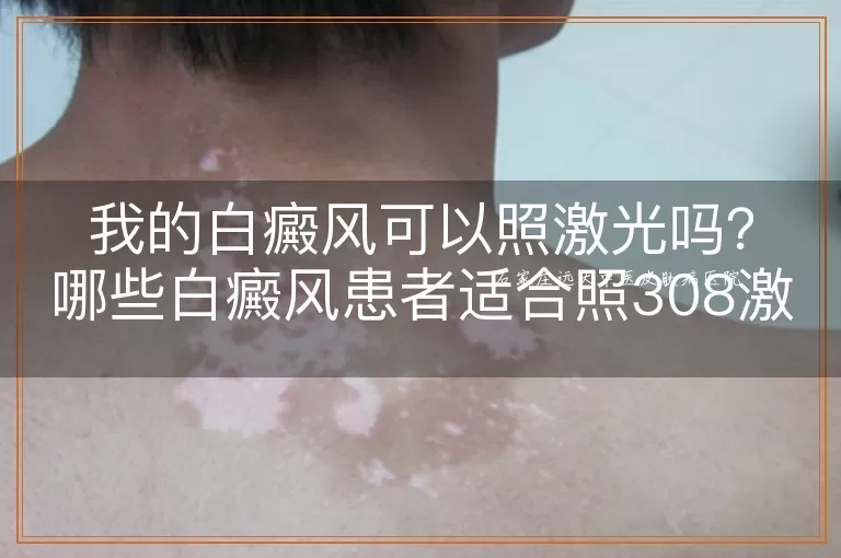 我的白癜风可以照激光吗？哪些白癜风患者适合照308激光？