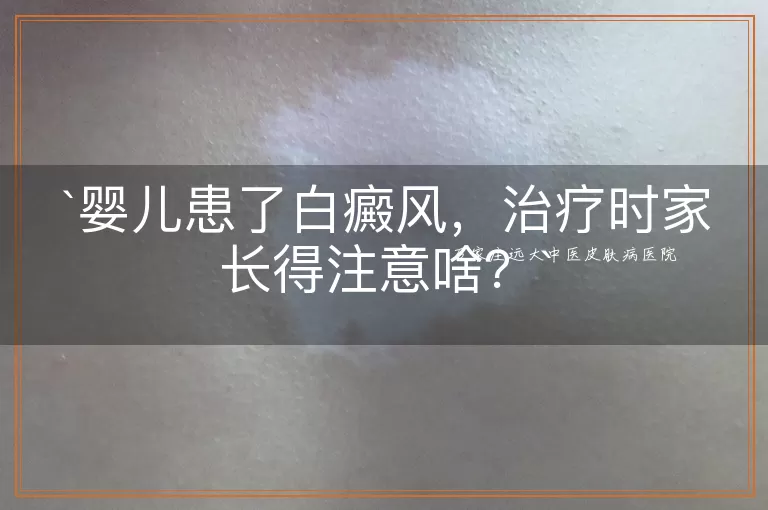 婴儿患了白癜风，治疗时家长得注意啥？
