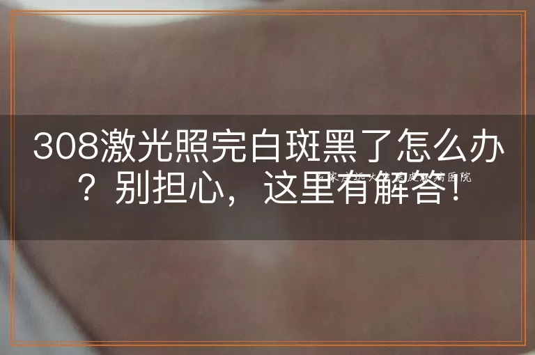 308激光照完白斑黑了怎么办？别担心，这里有解答！