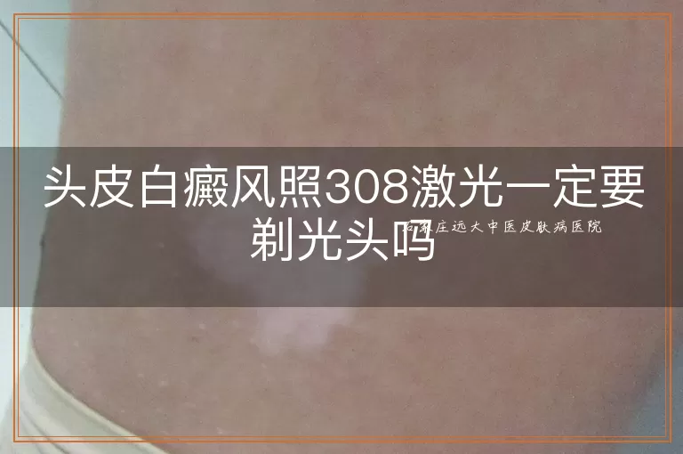 头皮白癜风照308激光一定要剃光头吗