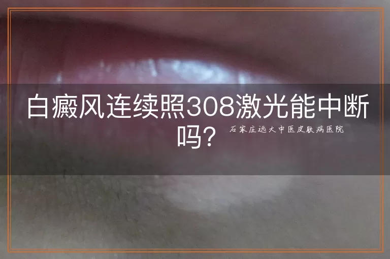 白癜风连续照308激光能中断吗?