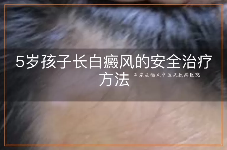 5岁孩子长白癜风的安全治疗方法