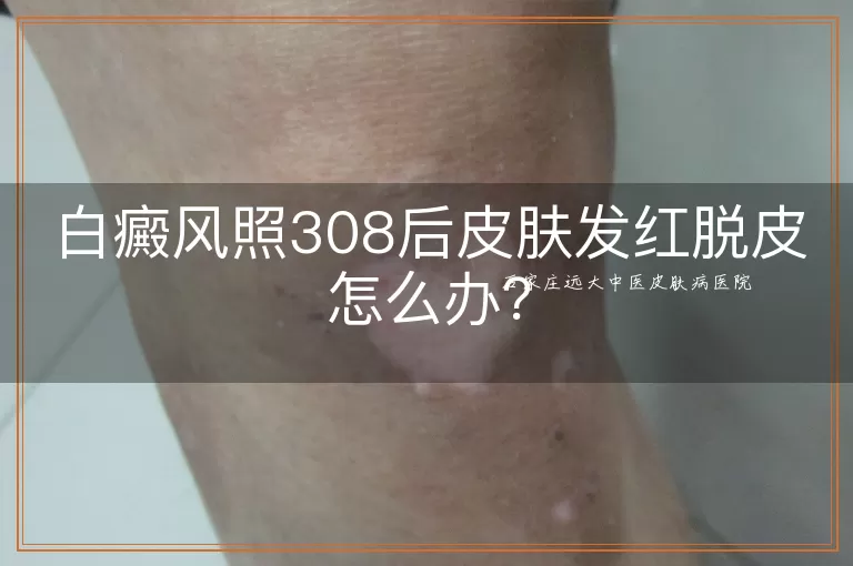 白癜风照308后皮肤发红脱皮怎么办？