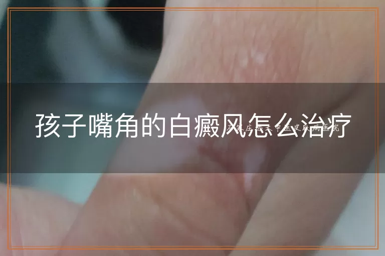 孩子嘴角的白癜风怎么治疗