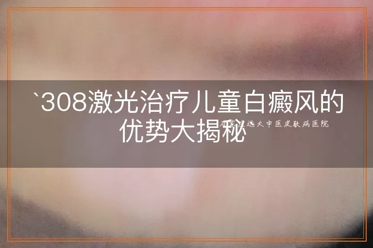 308激光治疗儿童白癜风的优势大揭秘
