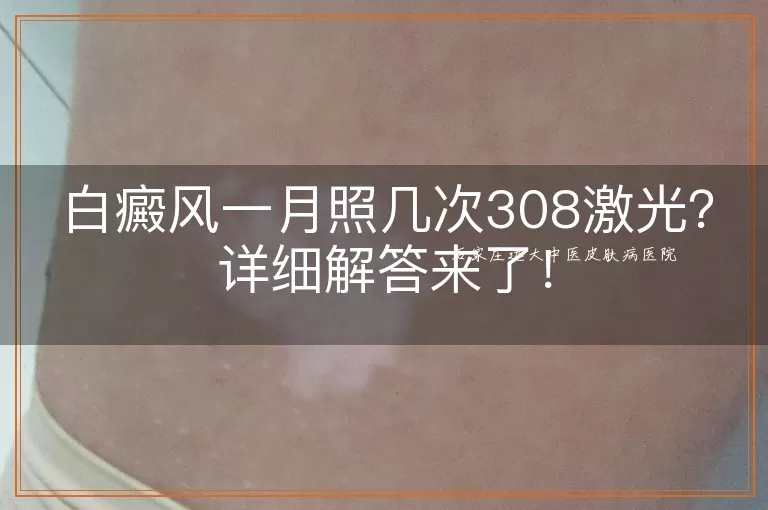 白癜风一月照几次308激光？详细解答来了！