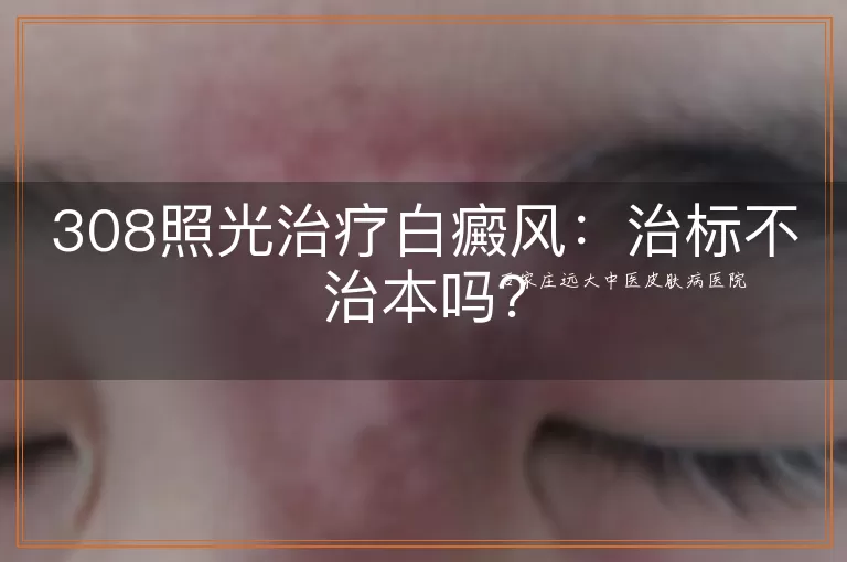 308照光治疗白癜风：治标不治本吗？
