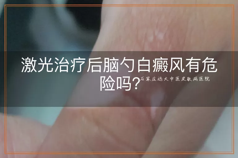激光治疗后脑勺白癜风有危险吗?