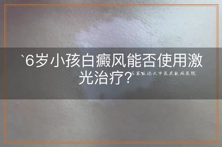 6岁小孩白癜风能否使用激光治疗?