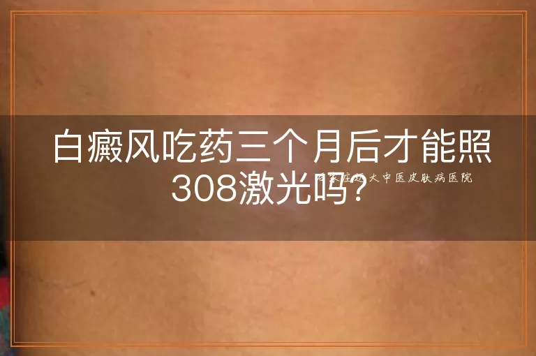 白癜风吃药三个月后才能照308激光吗？