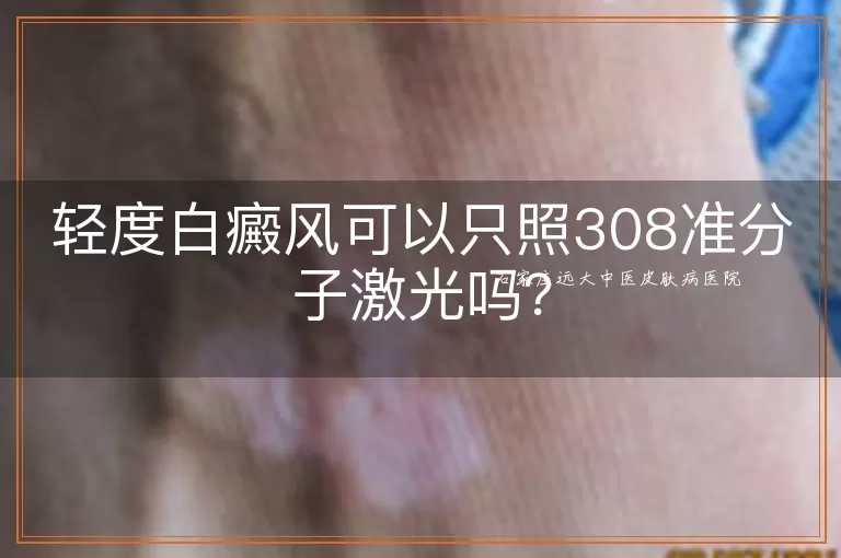 轻度白癜风可以只照308准分子激光吗?