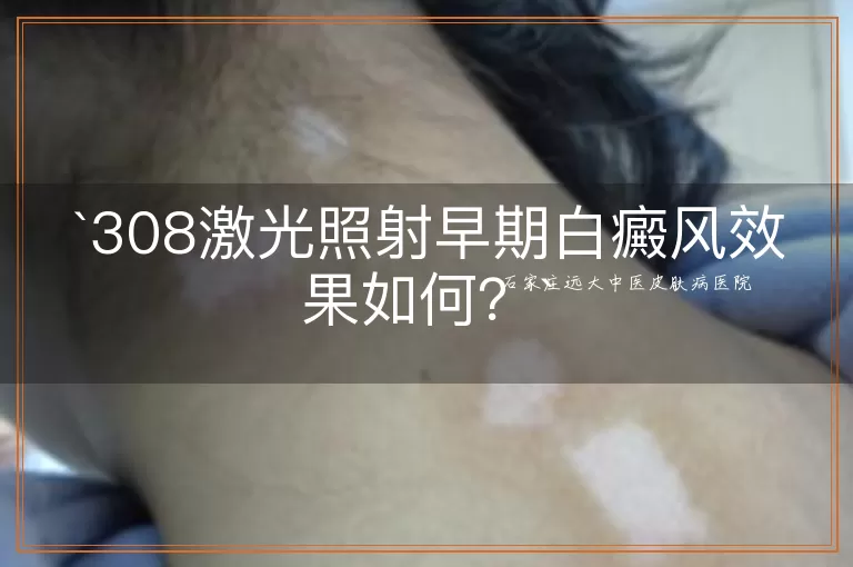 308激光照射早期白癜风效果如何?