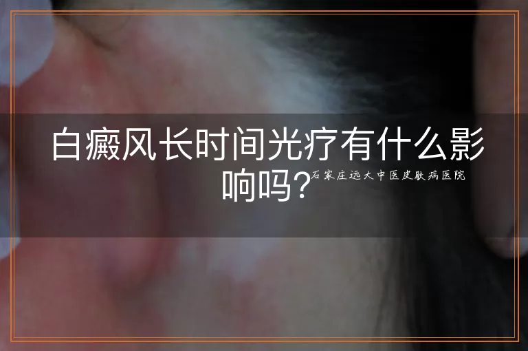 白癜风长时间光疗有什么影响吗?
