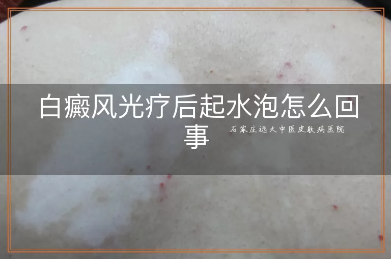 白癜风光疗后起水泡怎么回事