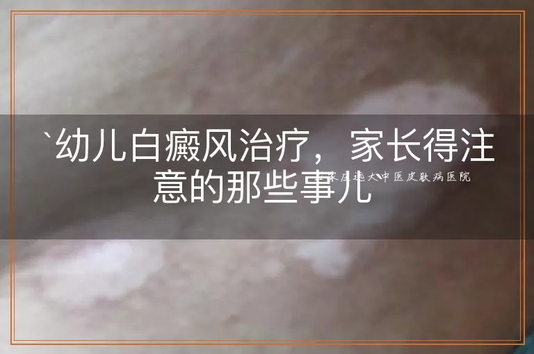 幼儿白癜风治疗，家长得注意的那些事儿