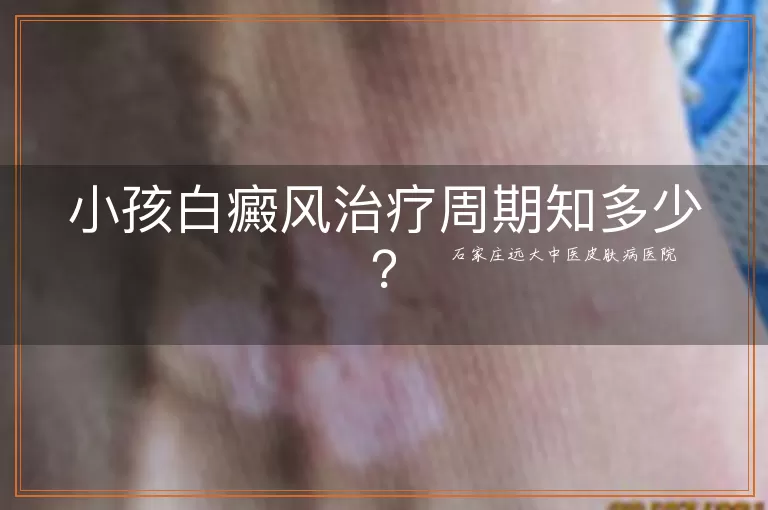 小孩白癜风治疗周期知多少？