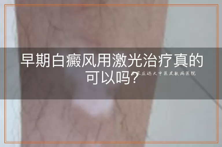 早期白癜风用激光治疗真的可以吗？