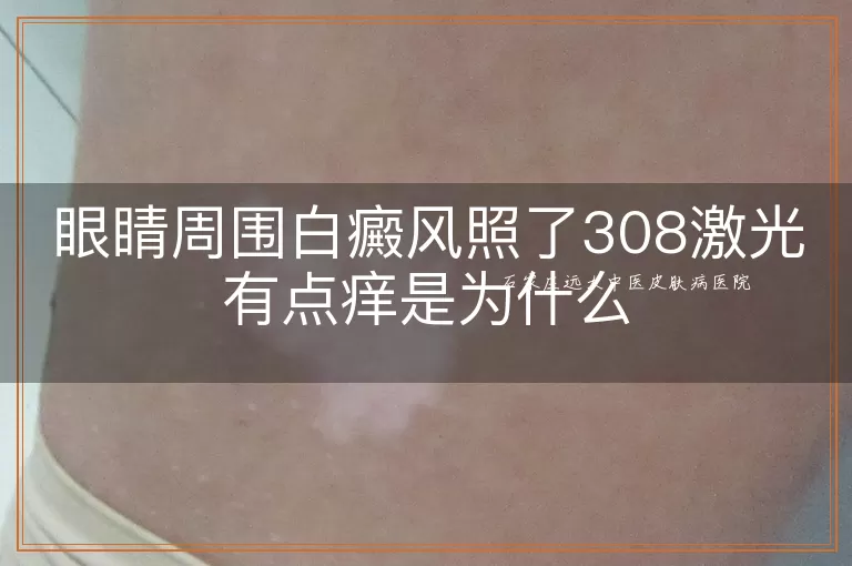 眼睛周围白癜风照了308激光有点痒是为什么