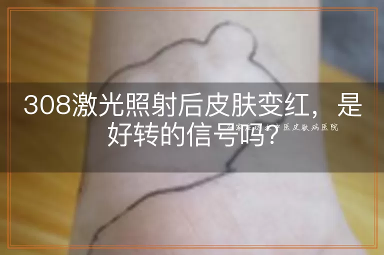 308激光照射后皮肤变红,是好转的信号吗?
