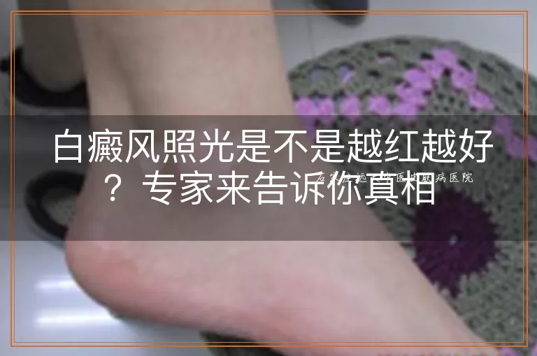 白癜风照光是不是越红越好?专家来告诉你真相