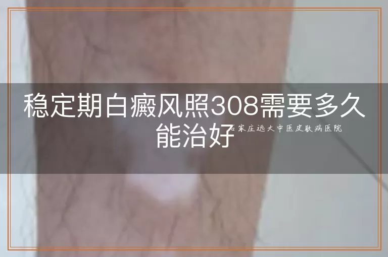 稳定期白癜风照308需要多久能治好