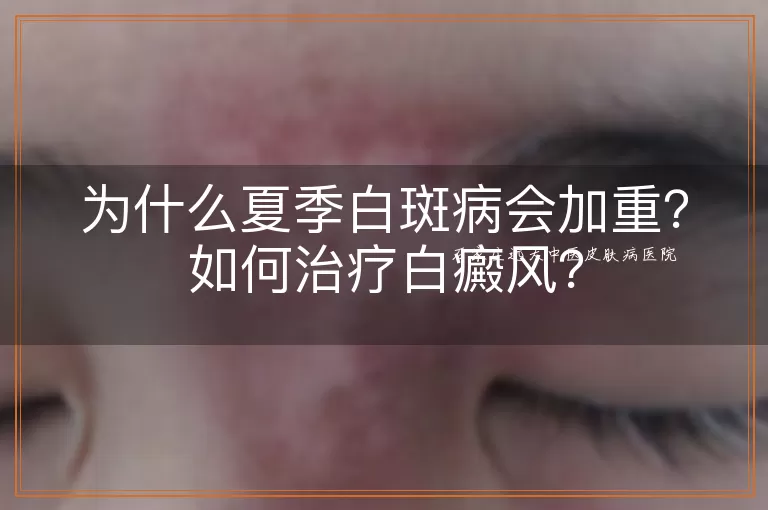 为什么夏季白斑病会加重？如何治疗白癜风？