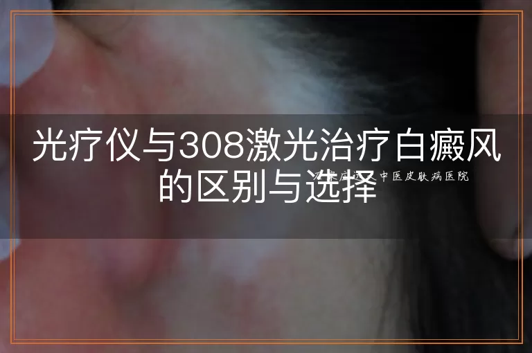 光疗仪与308激光治疗白癜风的区别与选择