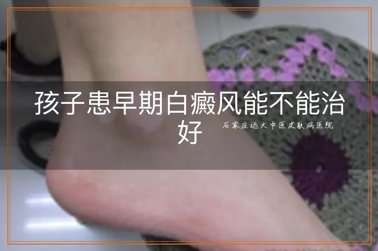 孩子患早期白癜风能不能治好