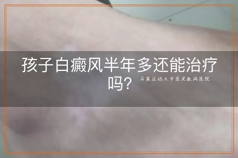 孩子白癜风半年多还能治疗吗？