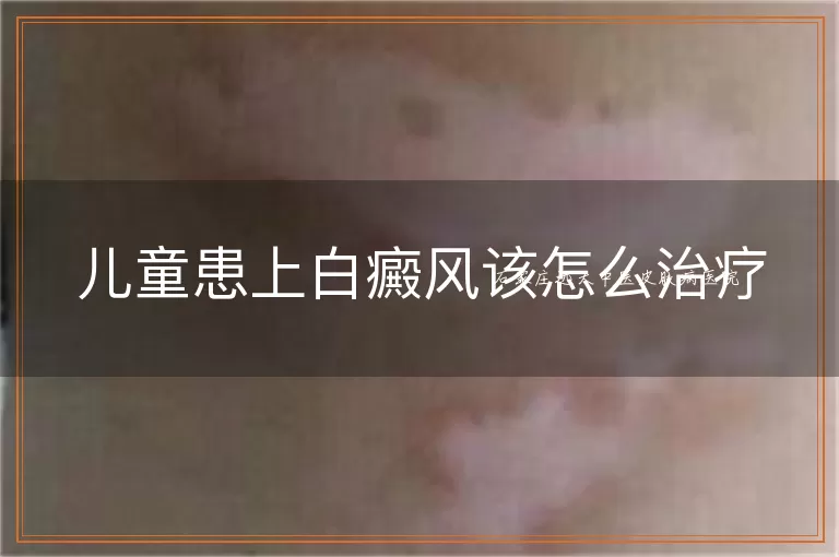 儿童患上白癜风该怎么治疗