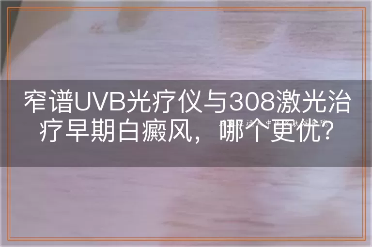 窄谱UVB光疗仪与308激光治疗早期白癜风，哪个更优？
