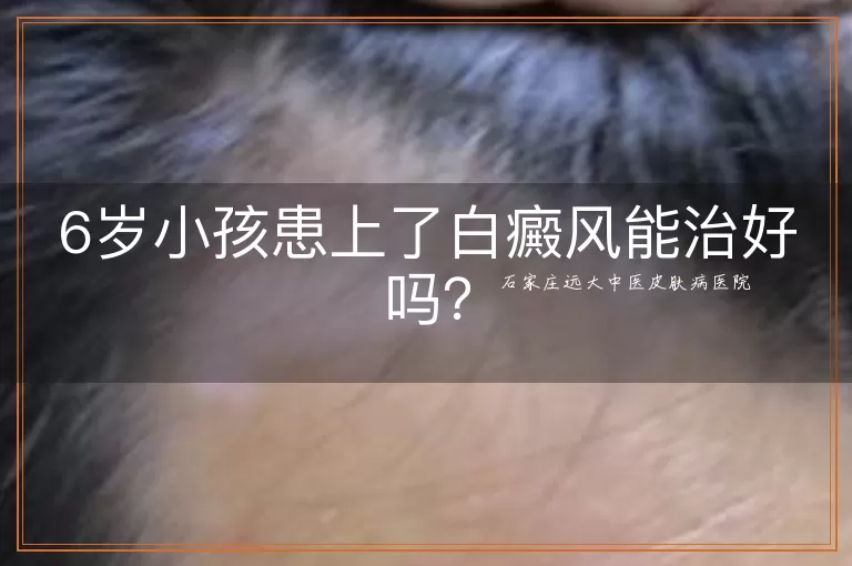 6岁小孩患上了白癜风能治好吗？